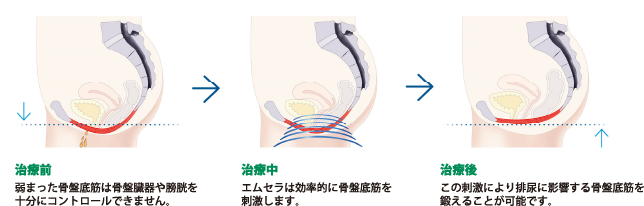 治療前:弱まった骨盤底筋は骨盤臓器や膀胱を十分にコントロールできません。治療中:エムセラは効率的に骨盤底筋を刺激します。治療後:この刺激により排尿に影響する骨盤底筋を鍛えることが可能です。